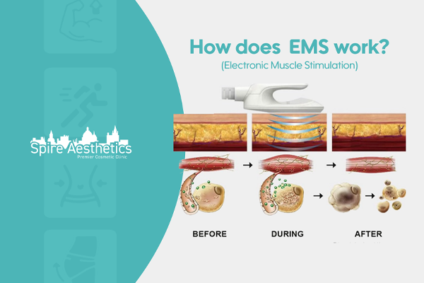 EMS treatment for post pregnancy weight loss treatment Selston