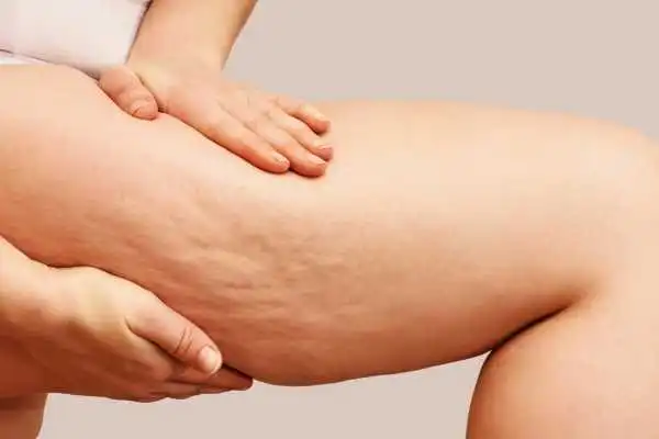 Image of woman showing leg with cellulite Selston