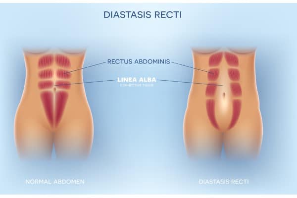 What Non-Surgical Options Are Available for Diastasis Recti Selston?
