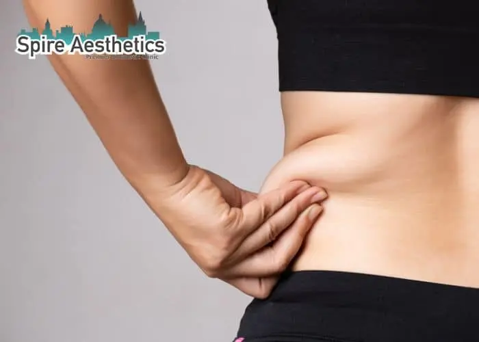 Image of woman pinching fat on their hips Selston. Fat Freezing treatment