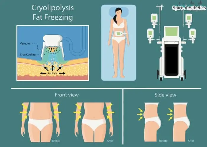 Fat freezing treatment Selston benefits for competitions to remove stubborn fat deposits.