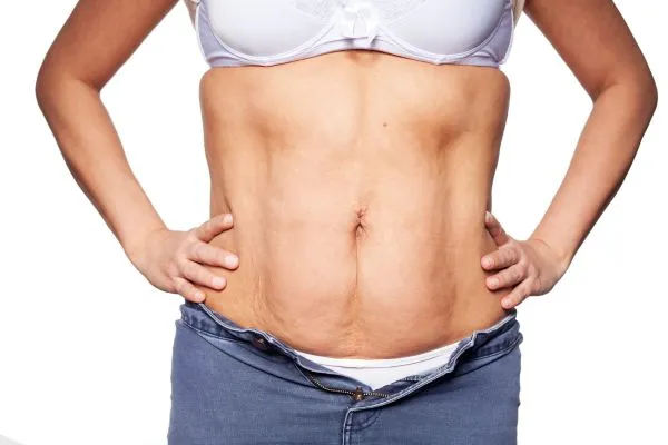 sagging skin on woman's stomach after weight loss injections Selston