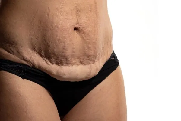 Image of womans stomach after weight loss injections Selston showing saggy skin