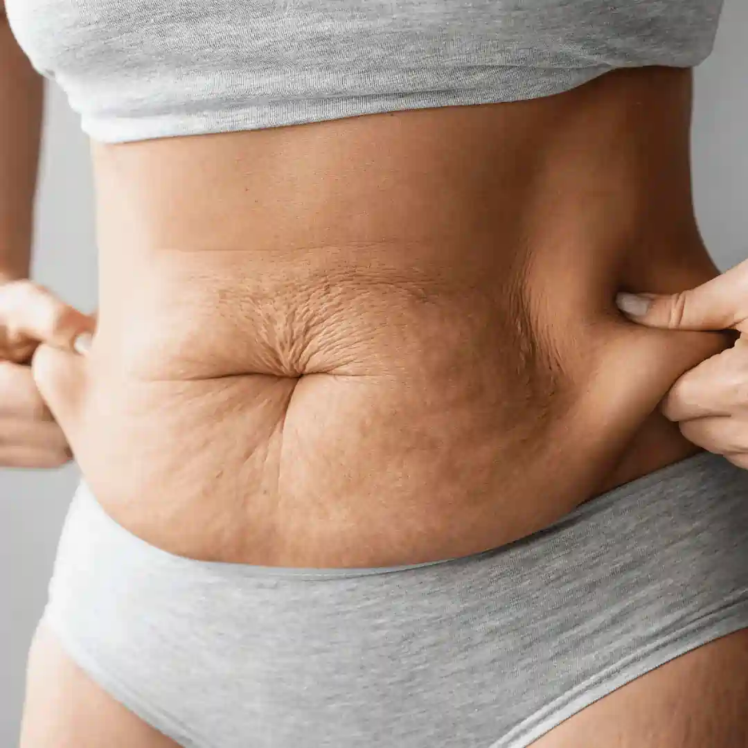 Is It Normal to Have Loose Skin After Pregnancy Selston?