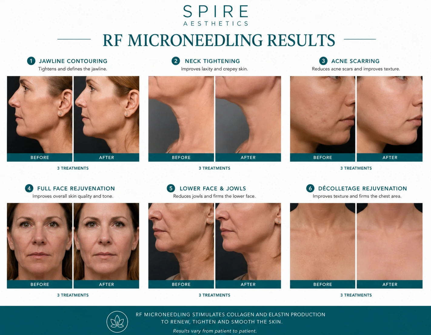 RF Microneedling Skin tightening Selston results