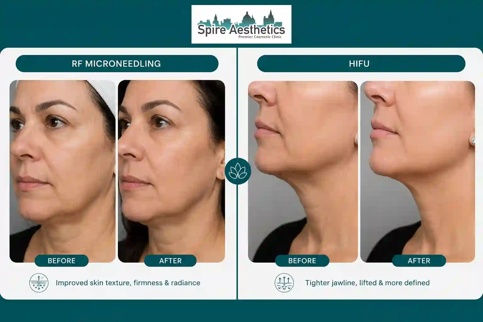 Can RF Microneedling and HIFU Be Combined Selston?