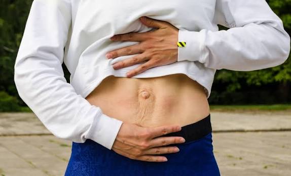 When Could Diastasis Recti Be the Missing Piece of the Puzzle Selston?