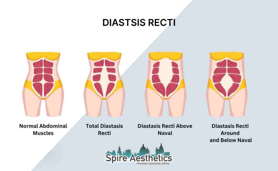 Is Non-Surgical Diastasis Recti Treatment Right for You? Common Concerns Answered Selston